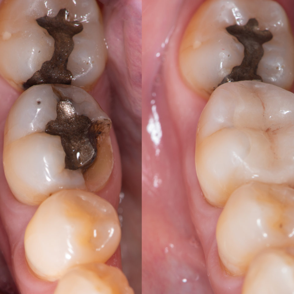 Close-up of molar teeth showing dental cavities with dark decay on the chewing surfaces.