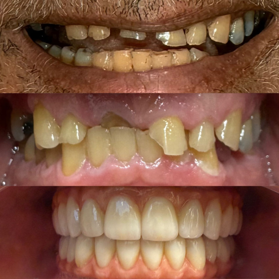 Three close-up views of a person's teeth, showing the progression from severely decayed and misaligned teeth to clean, straight, restored teeth.